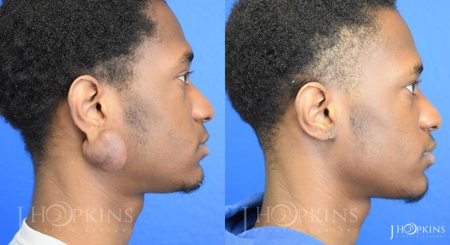 Keliod Scar Removal - Thumbnail 2