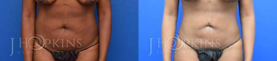 Liposuction - Case 10470