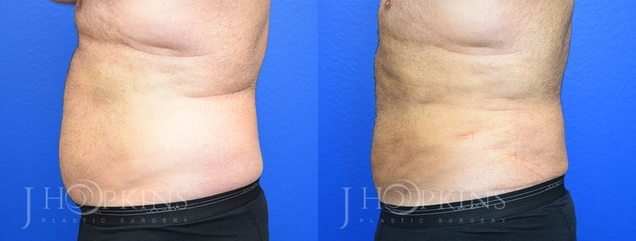 Liposuction - Case 10467