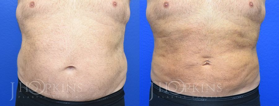 Liposuction - Thumbnail 2