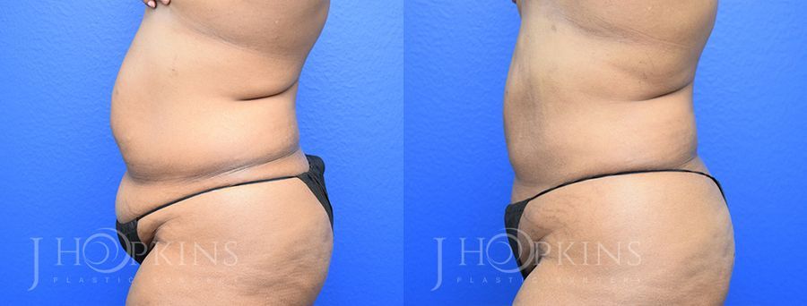 Liposuction - Thumbnail 2