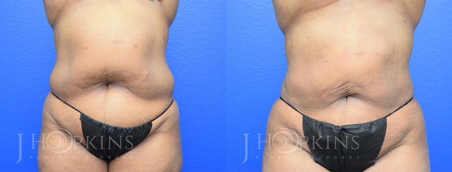 Liposuction - Case 10468