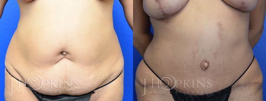 Mommy Makeover - Thumbnail 2