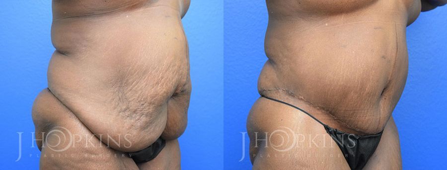 Panniculectomy (Body Lift) - Thumbnail 2