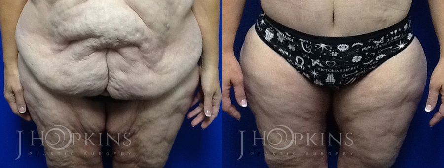 Panniculectomy (Body Lift) - Case 10496