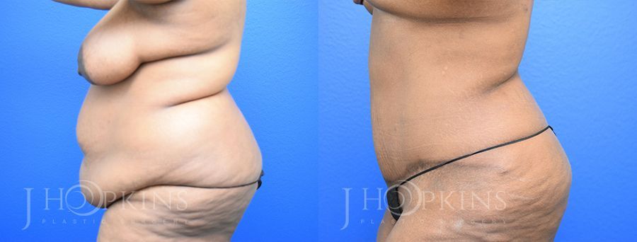 Panniculectomy (Body Lift) - Thumbnail 2