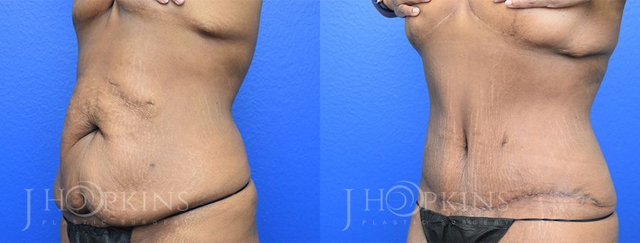 Panniculectomy (Body Lift) - Thumbnail 2