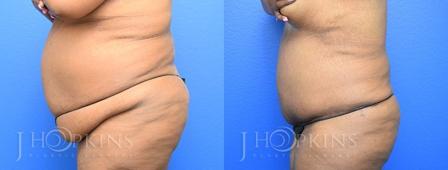 Panniculectomy (Body Lift) - Thumbnail 2