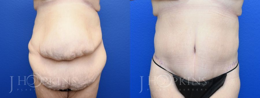 Panniculectomy (Body Lift) - Case 10501