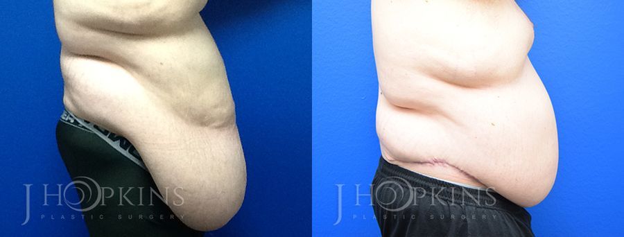 Panniculectomy (Body Lift) - Case 10494