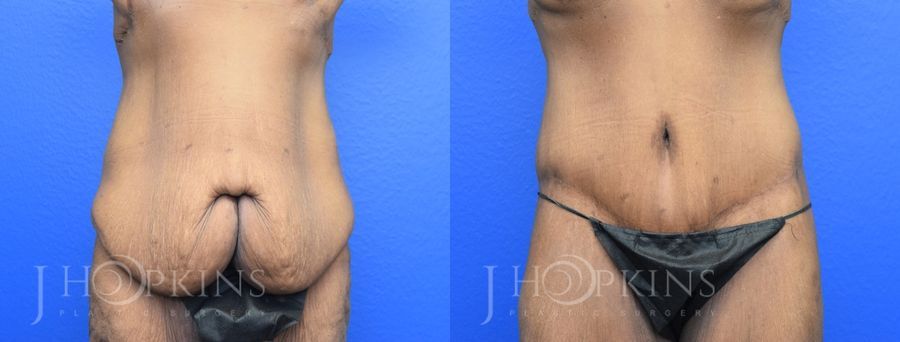 Panniculectomy (Body Lift) - Case 10486