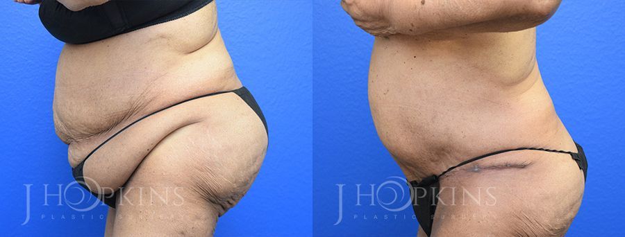 Panniculectomy (Body Lift) - Thumbnail 2