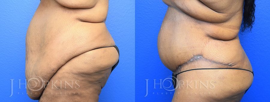 Panniculectomy (Body Lift) - Thumbnail 2