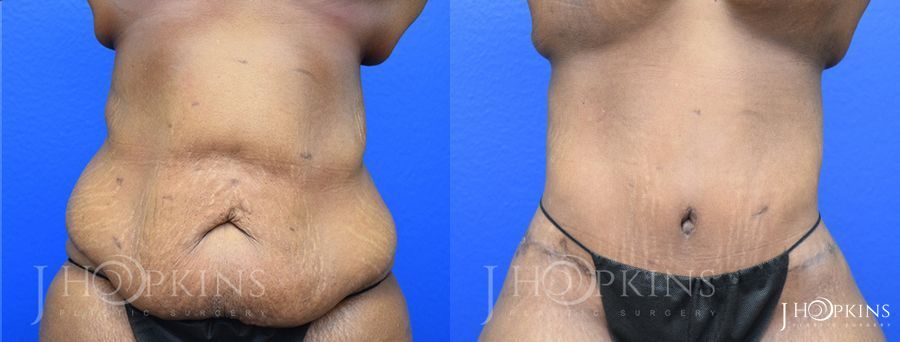 Panniculectomy (Body Lift) - Thumbnail 2