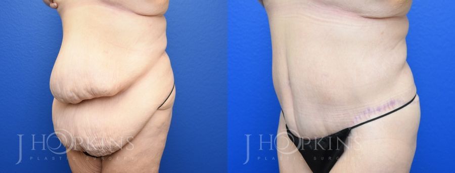 Panniculectomy (Body Lift) - Thumbnail 2