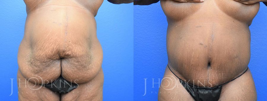 Panniculectomy (Body Lift) - Case 10488