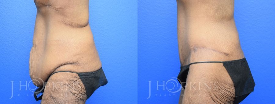 Panniculectomy (Body Lift) - Thumbnail 3