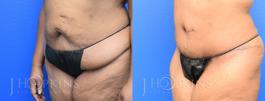 Panniculectomy (Body Lift) - Thumbnail 2