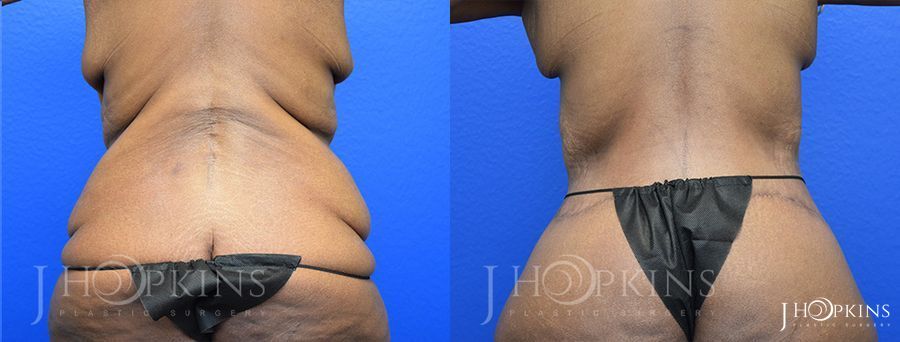 Panniculectomy (Body Lift) - Thumbnail 3