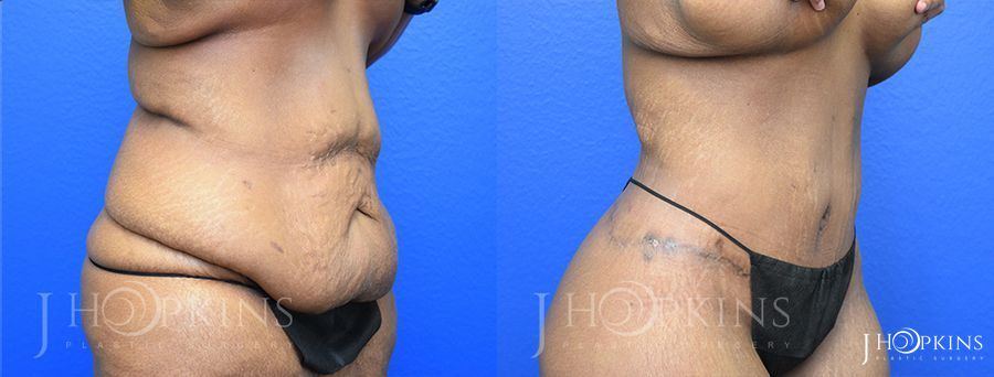 Before and after procedure result