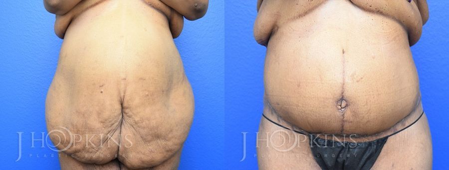 Panniculectomy (Body Lift) - Case 10491