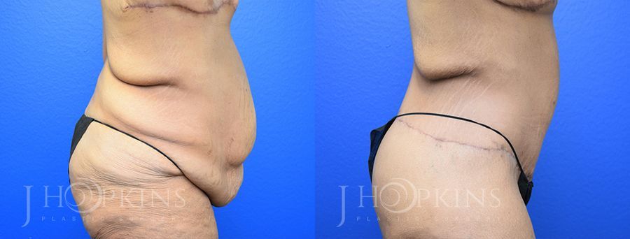 Panniculectomy (Body Lift) - Thumbnail 3