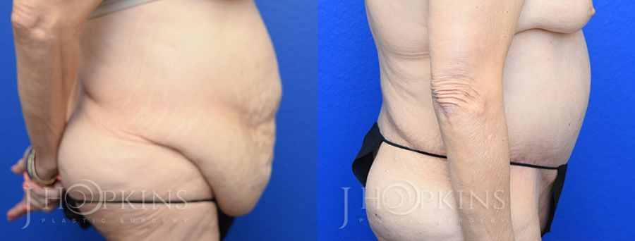 Panniculectomy (Body Lift) - Thumbnail 2