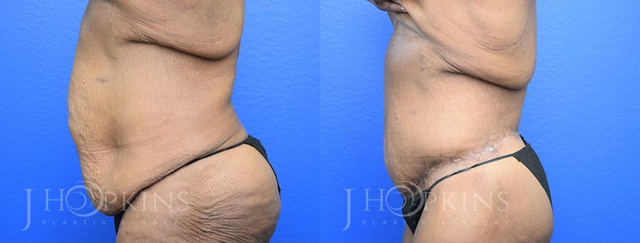 Panniculectomy (Body Lift) - Thumbnail 2