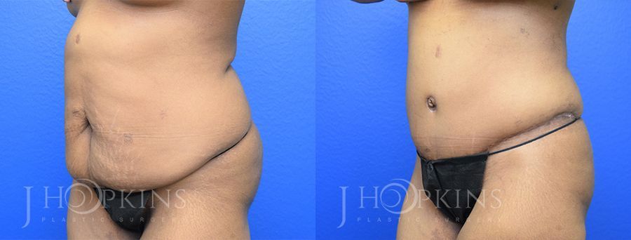 Panniculectomy (Body Lift) - Thumbnail 2