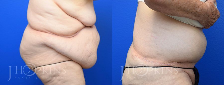 Panniculectomy (Body Lift) - Thumbnail 2