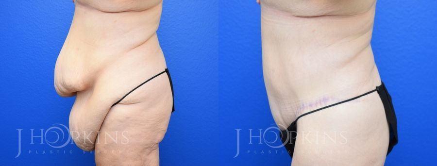 Panniculectomy (Body Lift) - Thumbnail 3