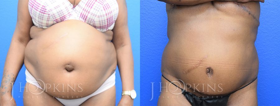 Panniculectomy (Body Lift) - Case 10492