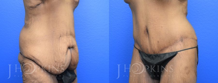 Panniculectomy (Body Lift) - Thumbnail 2