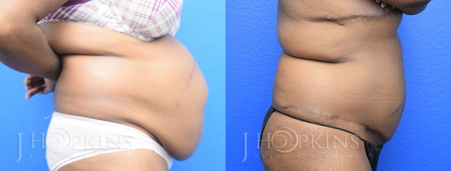 Panniculectomy (Body Lift) - Thumbnail 2