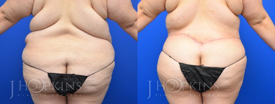 Panniculectomy (Body Lift) - Thumbnail 3