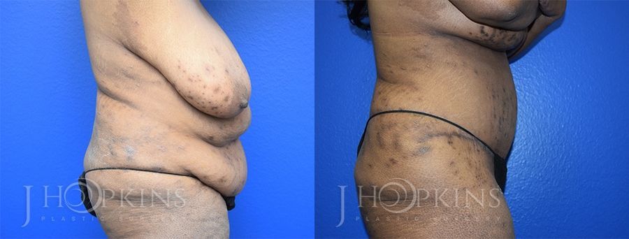 Panniculectomy (Body Lift) - Case 10482