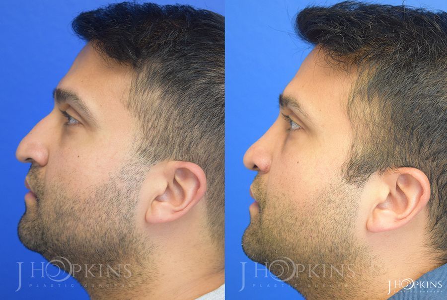 Rhinoplasty - Thumbnail 2