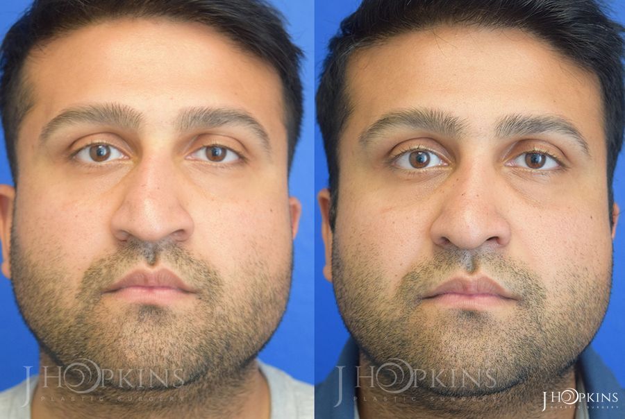 Rhinoplasty - Case 10587