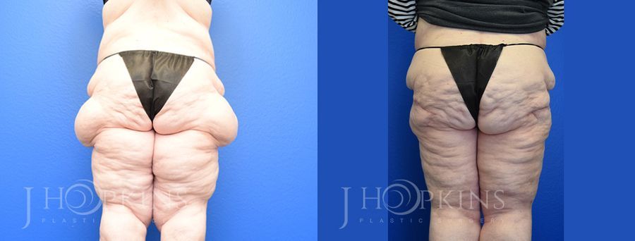 Thighplasty - Thumbnail 2