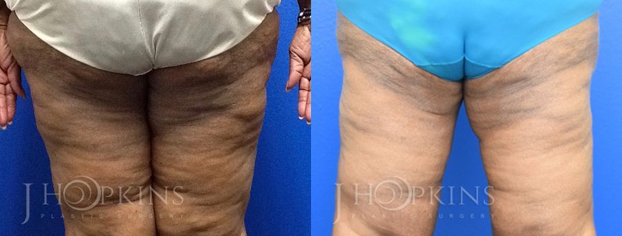 Thighplasty - Thumbnail 2