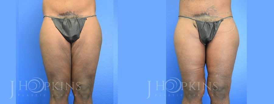Thighplasty - Case 10502