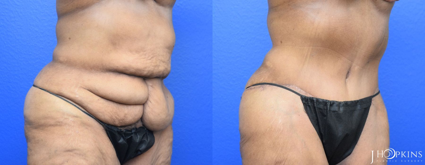 Tummy Tuck - Thumbnail 2