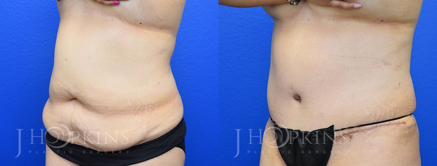 Tummy Tuck - Thumbnail 2