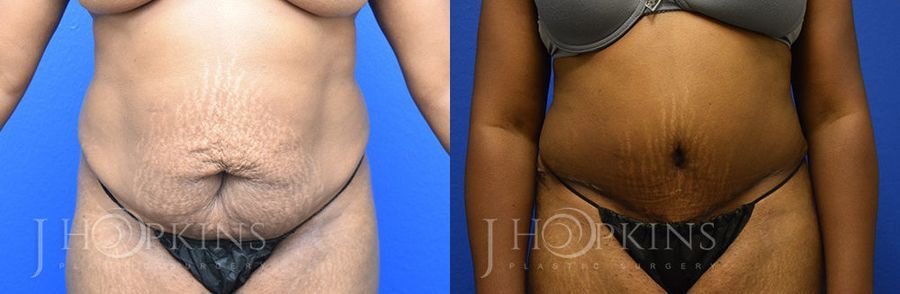 Tummy Tuck - Case 10517