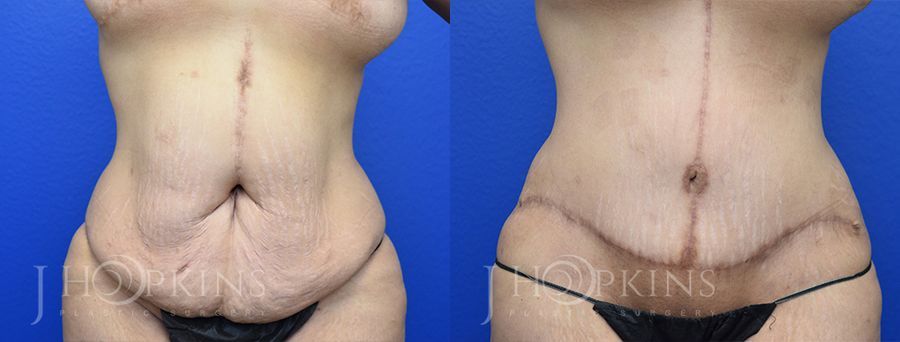 Tummy Tuck - Case 10515