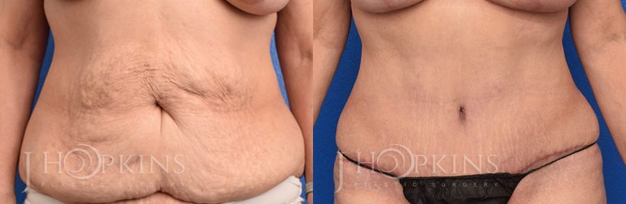 Tummy Tuck - Case 10509