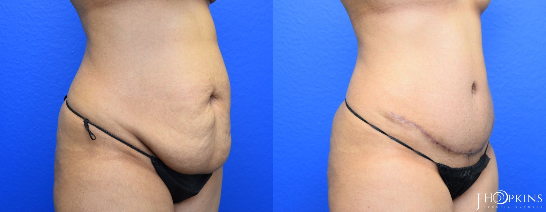 Tummy Tuck - Thumbnail 2