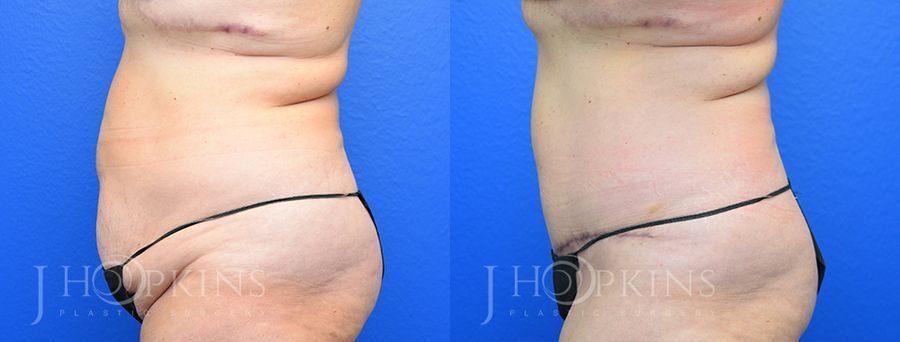 Tummy Tuck - Thumbnail 2