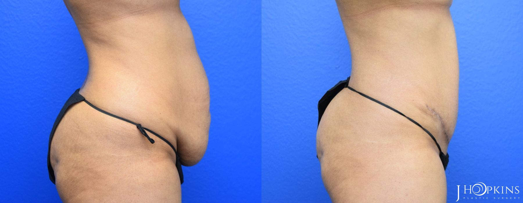 Tummy Tuck - Thumbnail 3