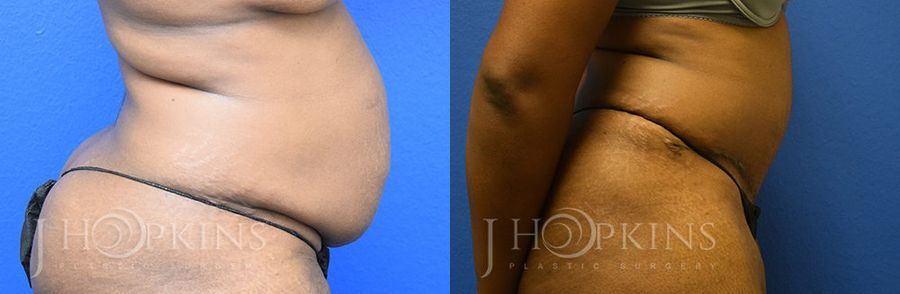 Tummy Tuck - Thumbnail 2